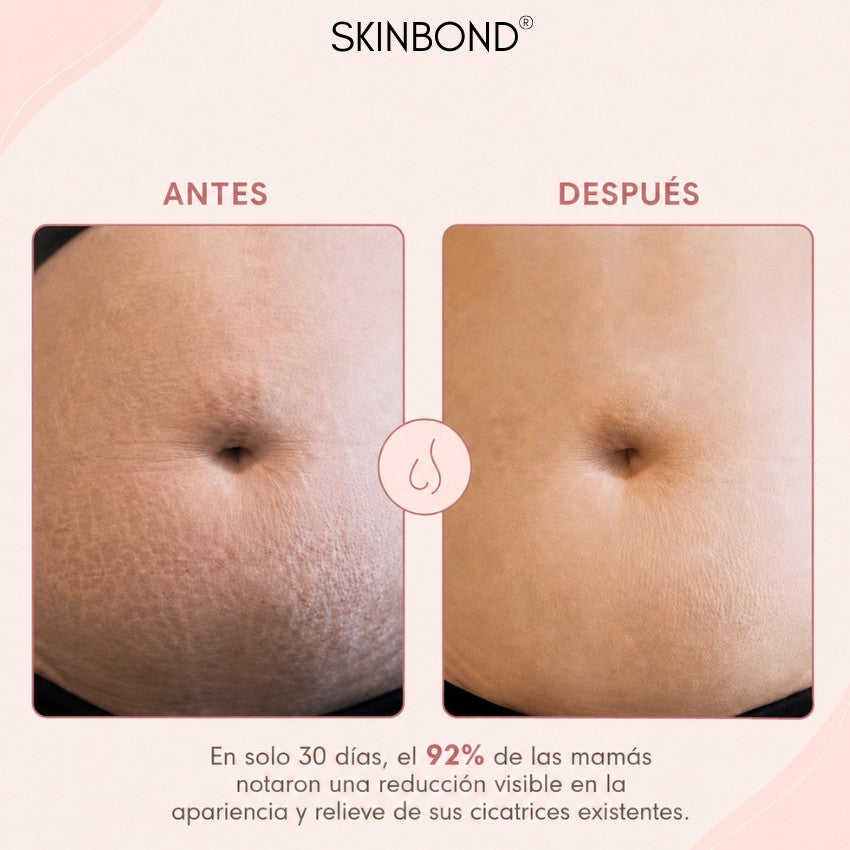 SkinBond Aceite - Cicatrices y estrías menos visibles en semanas