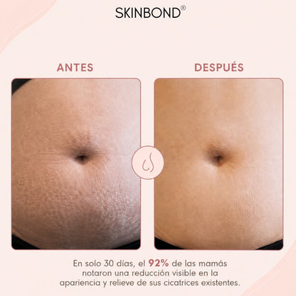 SkinBond Aceite - Cicatrices y estrías menos visibles en semanas