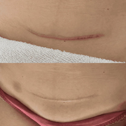 SkinBond – Láminas de silicona para cicatriz de cesárea