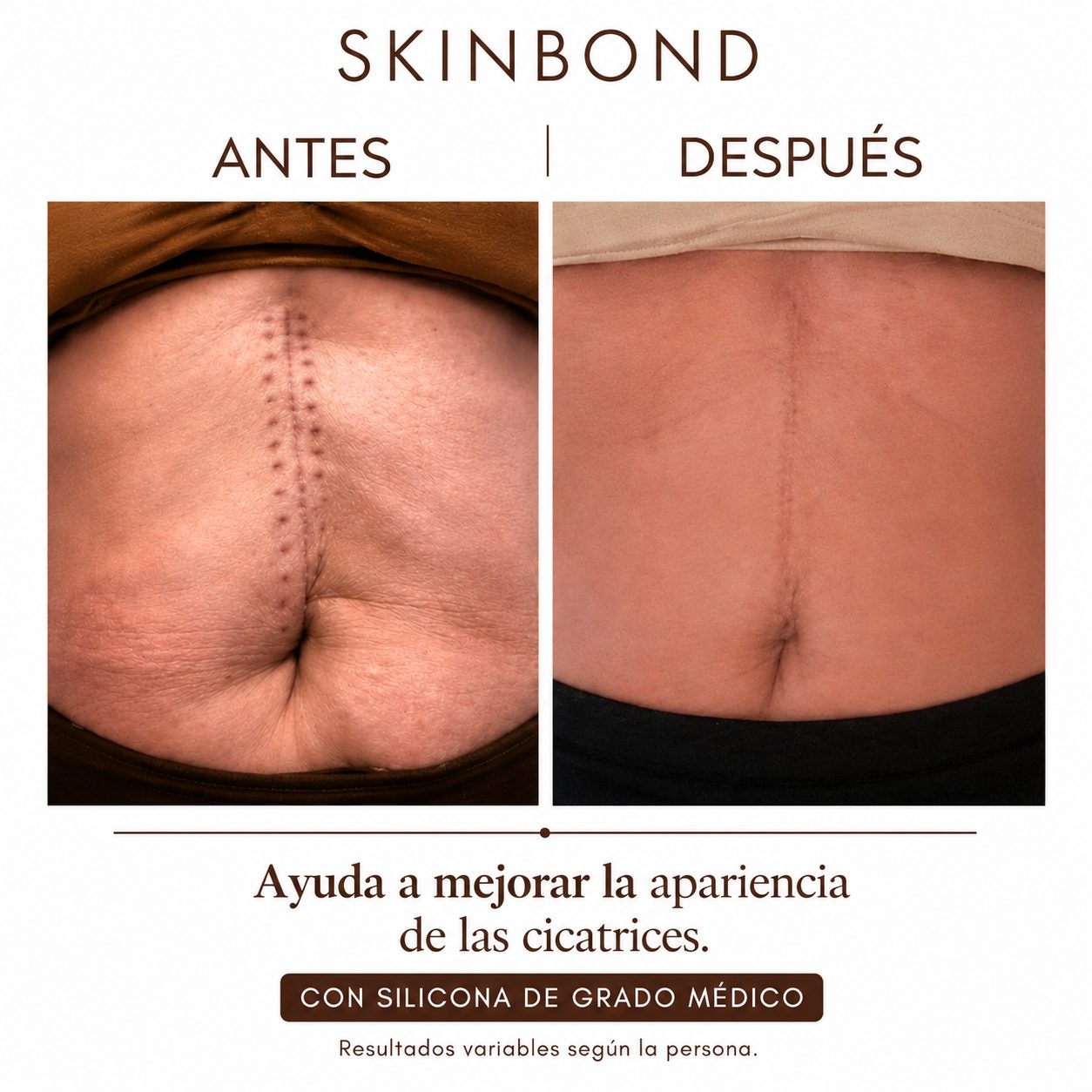 SkinBond - Cicatrices menos visibles en semanas