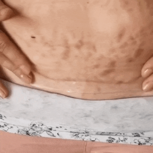 SkinBond – Láminas de silicona para cicatriz de cesárea